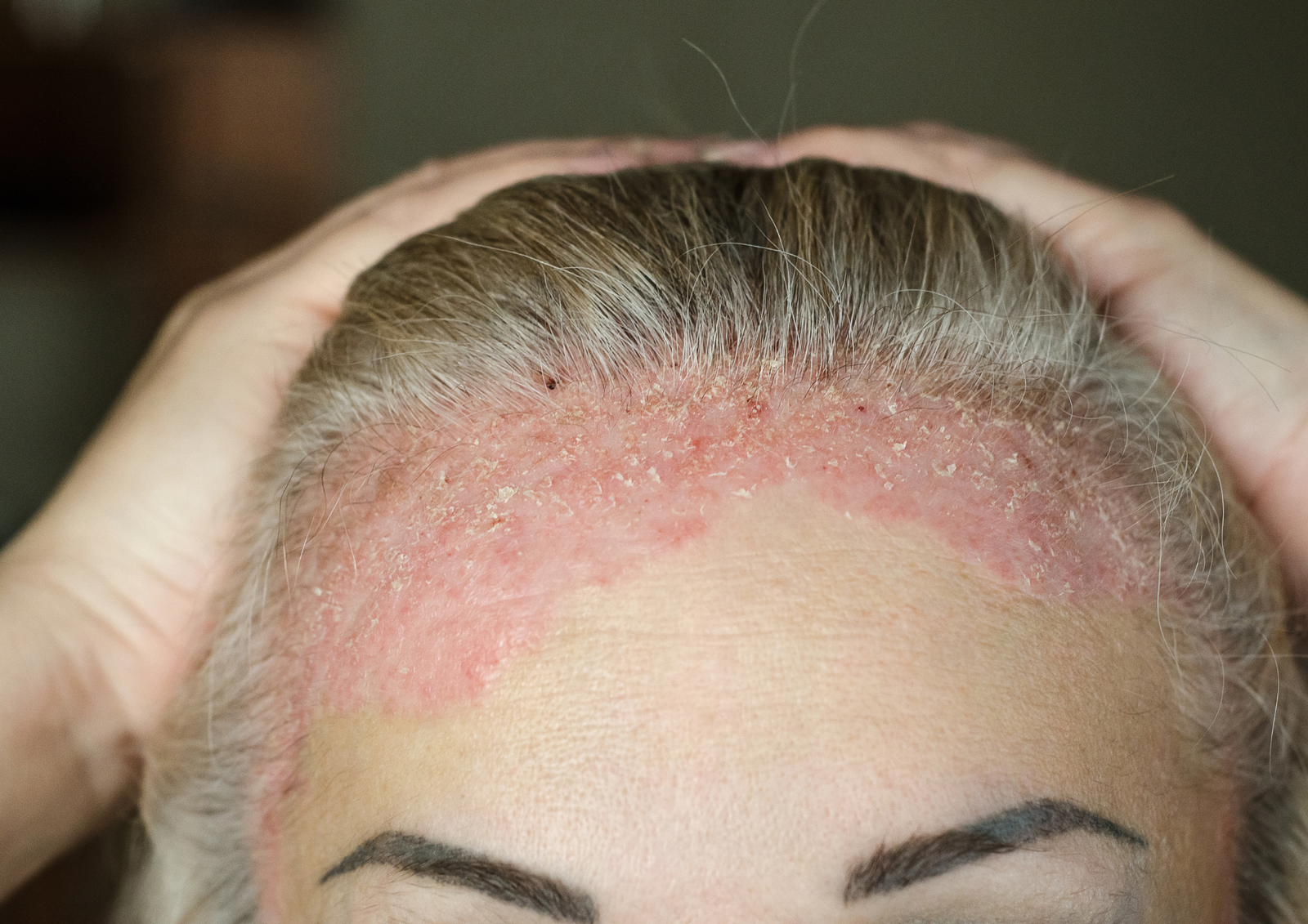 Skin Allergies Treatment Image